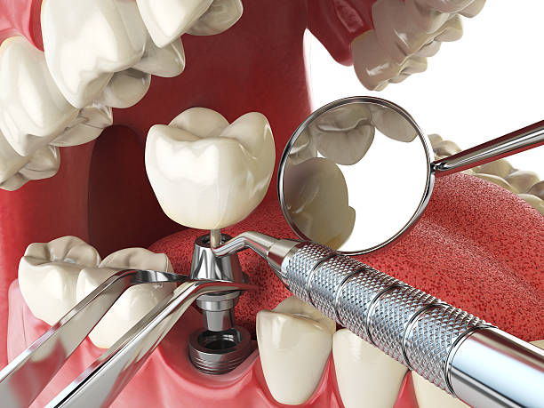 Best Emergency Dental Care for Broken or Chipped Teeth in Meridian, PA